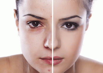 How to get rid of your blemishes permanently